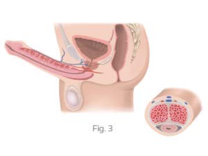 El dispositivo de terapia de ondas de choque extracorpórea mejora la disfunción eréctil masculina ED mejora el pene